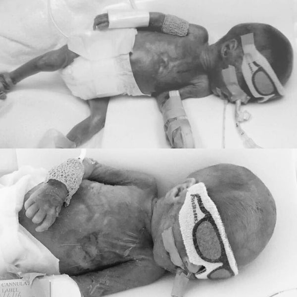 "All we had was hope" : the story of 23 weeker twins